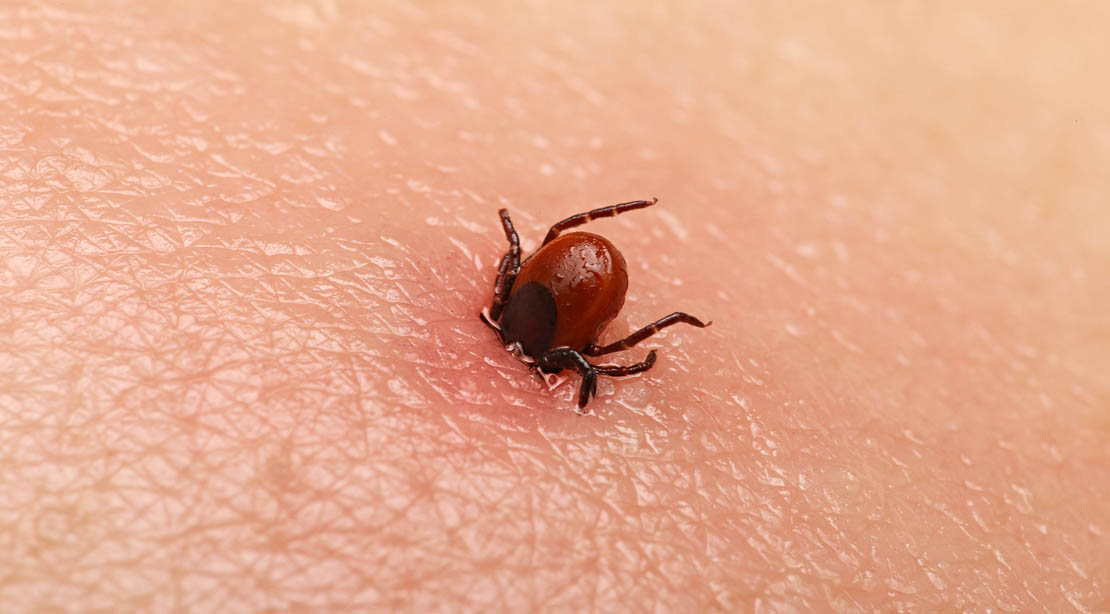 A tick embedded in human skin. Avoid ticks! How common are tick bites?